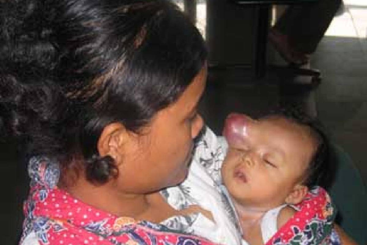 Seorang Bayi Berusia 3 Bulan Penderita Tumor
